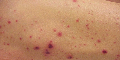 Cách Sử Dụng Cây Long Nha Thảo Để Trị Ban Xuất Huyết Do Giảm Tiểu Cầu