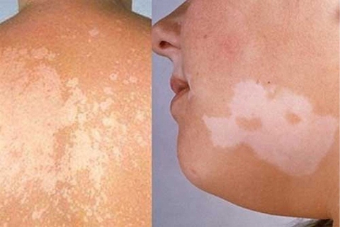 Mách Bạn Cách Phòng Ngừa Lang Beng Từ Vị Thuốc Vọng Cách