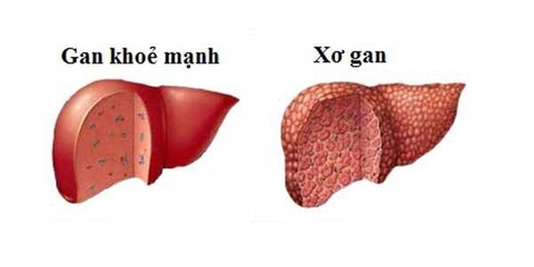 Xơ Gan Là Gì ? Tìm Hiểu Về Nguyên Nhân Biến Chưng Của Bệnh Nhân Xơ Gan