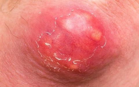 Bí Quyết Trị Mụn Nhọt Hiệu Quả Từ Con Rết