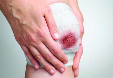 Tác Dụng Của Cây Hoa Hòe Trong Việc Cầm Máu