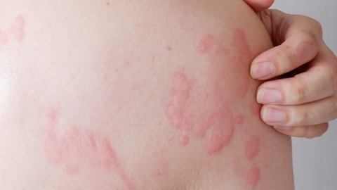 Nẩm Ngứa Viêm Loét Ngoài Da : Cách Chữa Bằng Cây Đơn Trắng Từ Tự Nhiên An Toàn ,Hiệu Quả