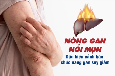 Thói Quen Giúp Giảm Mụn Nhọt Thanh Nhiệt Gan Từ Vị Thuốc Cà Gai Leo