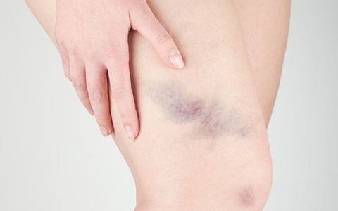 Mẹo Xua Tan Ứ Huyết Do Chấn Thương , Té Ngã Từ Cỏ Nến Hiệu Quả An Toàn