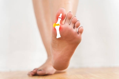 Cách Sử Dụng Cây Khế Rừng Để Hỗ Trợ Điều Trị Gout