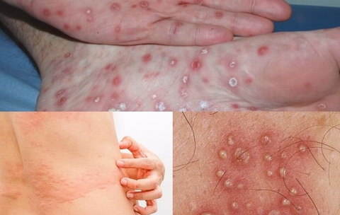 Chữa Trị Bệnh Ghẻ và Giang Mai Hiệu Quả Bằng Hạt Cây Đại Phong Tử