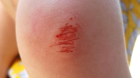 Chống Sưng Chống Viêm Hiệu Quả Nhờ Cây Gừng Dại