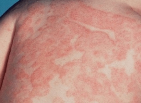 Trị Nấm ,Viêm Da Hiệu Quả Tại Nhà Bằng Cây Thuốc Cúc Liên Chi Dại