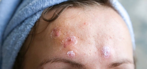 Cách Sử Dụng Cây Nàng Nàng Để Hỗ Trợ Điều Trị Mụn Nhọt Và Lỡ Loét Ngoài Da