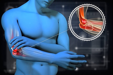 Đau Dây Thần Kinh Toạ Và Cách Chữa Trị Bằng Móng Lưng Rồng