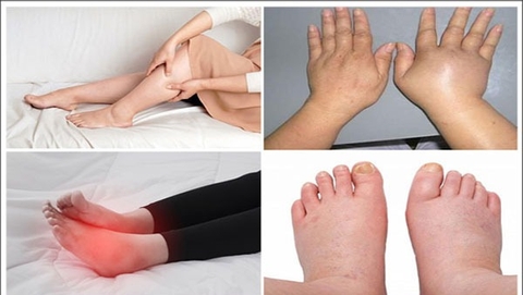 Cách Sử Dụng Cây Đỗ Trọng Hiệu Quả  Để Chữa Sưng Tê Phù