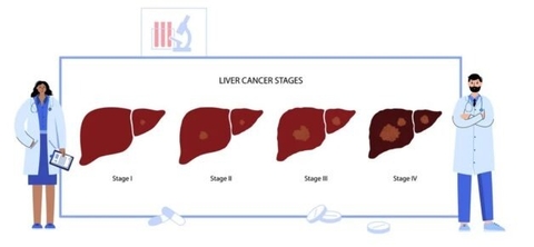 Ung Thư Gan Có Mấy Giai Đoạn , Chiệu Trứng Và Cách Nhận Biết