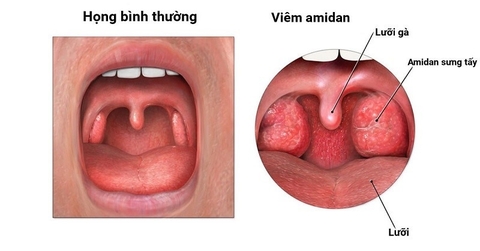 VIêm Họng Và Cách Chữa Trị Từ Thảo Dược Chua Me Đất Hoa Vàng