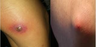 Cách Sử Dụng Cây Thương Lục Để Điều Trị Mụn Nhọt, Mụn Đầu Đinh Hoặc Mủ Da