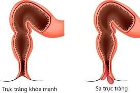 Cách Sử Dụng Cây Móng Lưng Rồng Để Hỗ Trợ Điều Trị Sa Thực Tràng