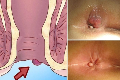 Ngăn Ngừa Và Chữa Trị Bệnh Trĩ Ngay Tại Nhà Hiệu Quả Với Vị Thuốc Huyết Dụ