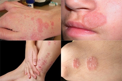 Chữa Trị Ghẻ Ngứa Và Các Bệnh Ngoài Da Từ Cây Nghể