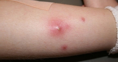 Cách Sử Dụng Cây Găng Tu Hú Để Chữa Trị Mụn Nhọt và Lỡ Loét