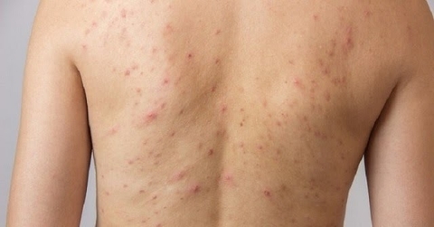 Nổi Mụn Ở Lưng Do Đâu , Tìm Hiểu Nguyên Nhân Và Cách Chữa Trị