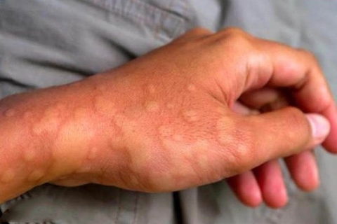 Cây Rau Đắng:  Điều Trị Mụn Nhọt, Ghẻ Lở, Mề Đay Mẩn Ngứa và Dị Ứng