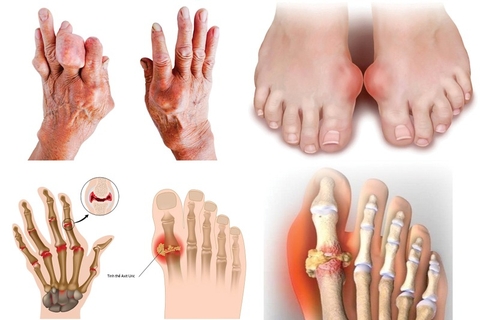 Cách Sử Dụng Ngũ Gia Bì Tốt Nhất Để Chữa Bệnh Gout