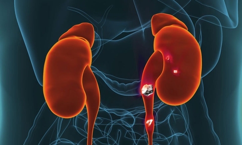 Phòng Ngừa Và Chữa Trị Sỏi Tiết Niệu Hiệu Quả  Bằng Vị Thuốc Cỏ Bợ