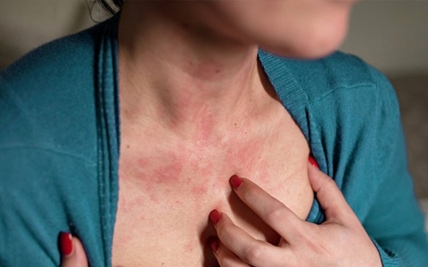 Trị Chàm Hiệu Quả Từ Vị Thuốc Ngô Thù Du Trong Y Học Cổ Truyền