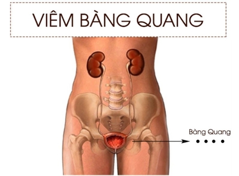 Cách Sử Dụng Cây Rau Đắng Để Hỗ Trợ Điều Trị Viêm Bàng Quang Cấp Tính