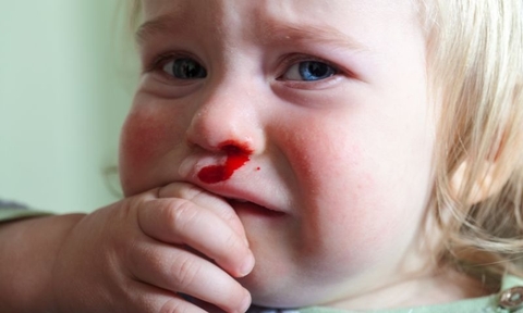 Mẹo Phòng Ngừa Và Chữa Trị Chảy Máu Cam Ở Trẻ Nhỏ