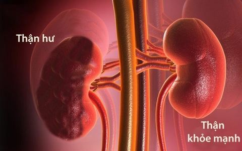 Cây Ba Kích Trị Chứng Thận Hư Thận Yếu Theo Phương Phấp Y Học Cổ Truyền