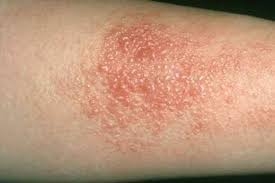 Chữa Trị Viêm Da, Mẩn Ngứa Bằng Cây Đơn Tướng Quân