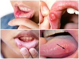 Tác Dụng Của Cây Rau Đắng Trong Việc Hỗ Trợ Điều Trị Nhiệt Miệng