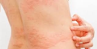 Bệnh Sán Cho Từ Thú Cưng Của Bạn Và Cách Chữa Trị Từ Cây Nghể