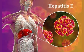 Viêm Gan E Là Bệnh Gì ? Có Nguỷ Hiểm Không , Cách Phòng Tránh Và Chữa Trị