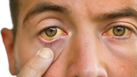 Vàng Da Là Bệnh Gì ? Tìm Hiểu Các Nguyên Nhân Dẫn Đến Vàng Da Ở Người