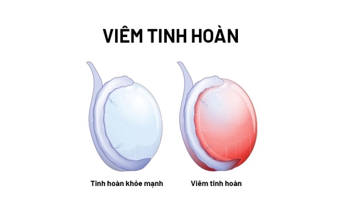 Viêm Tinh Hoàn Do Quai Bị Và Cách Phòng Ngừa Chữa Trị Từ Ngũ Gia Bì