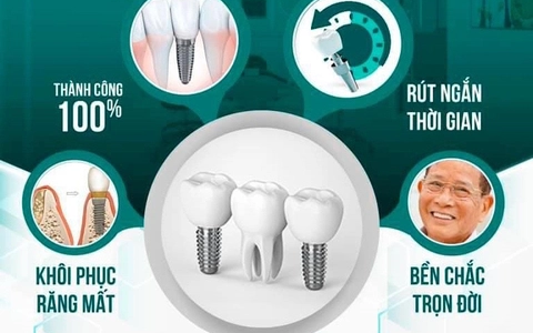 Cấy ghép Implant