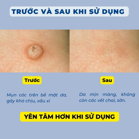 Miếng dán mụn cóc lành tính giúp loại bỏ, ngăn chặn mụn cóc (6 miếng)