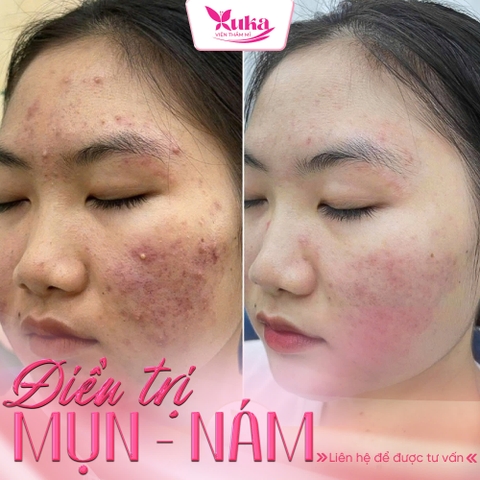 TRỊ THÂM MỤN MẶT