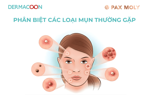 CÁC LOẠI MỤN THƯỜNG GẶP VÀ BÍ QUYẾT ĐIỀU TRỊ ĐÚNG CÁCH TỪ CHUYÊN GIA DA LIỄU