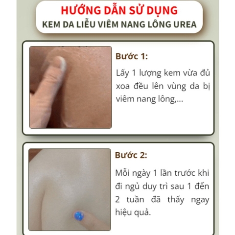 Kem da liễu viêm nang lông UREA đào thải bít tắc lỗ chân lông, cấp ẩm ngăn ngừa mụn, chăm sóc da khỏe mạnh  - HTHshop102