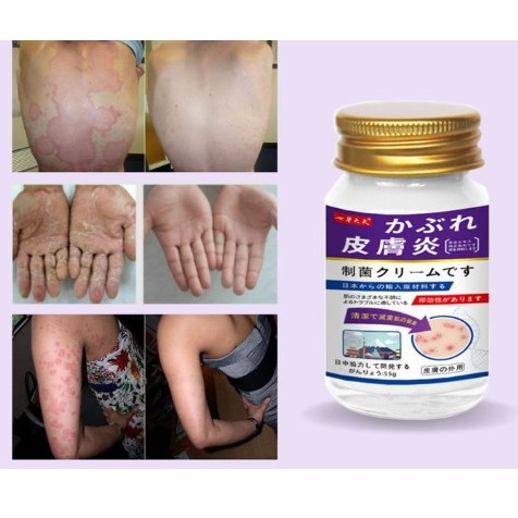 [Chính Hãng] Kem Nakusa Bôi Nấm Ngứa Viêm Da Cơ Địa NHẬT BẢN