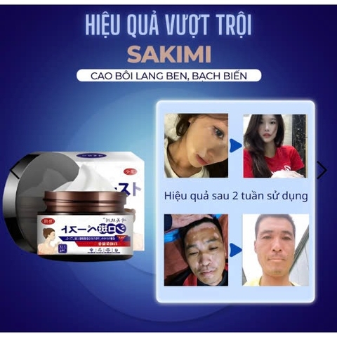 Cao bôi SaKiMi làm mờ Lang ben, Bạch biến, Hắc lào. Lấy lại làn da hoàn hảo chỉ sau 1 liệu trình - HTHshop102