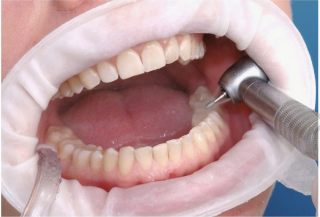 Banh môi Optragates