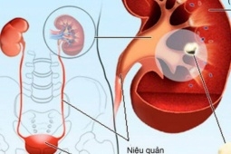 7 cách phòng bệnh sỏi thận dễ thực hiện