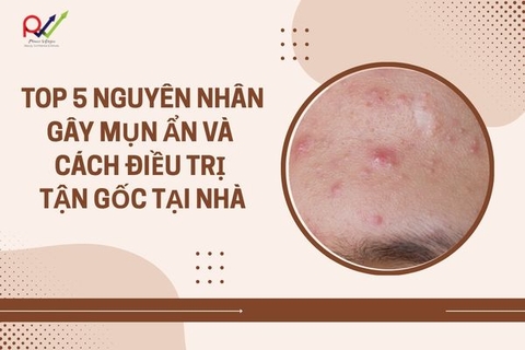 Top 5 Nguyên Nhân Gây Mụn Ẩn Và Cách Khắc Phục Tận Gốc Tại Nhà