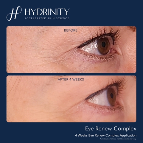 HYDRINITY Eye Renew Complex: Tinh Chất Tái Sinh Vùng Mắt - Giải Pháp Xóa Nhăn, Mờ Thâm Đa Tác Động