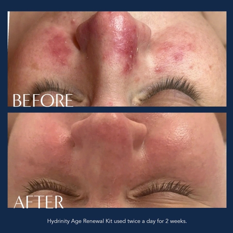 HYDRINITY Restorative HA Serum: Tinh Chất Cấp Ẩm Chuyên Sâu, Phục Hồi Tức Thì Với HA Siêu Nạp