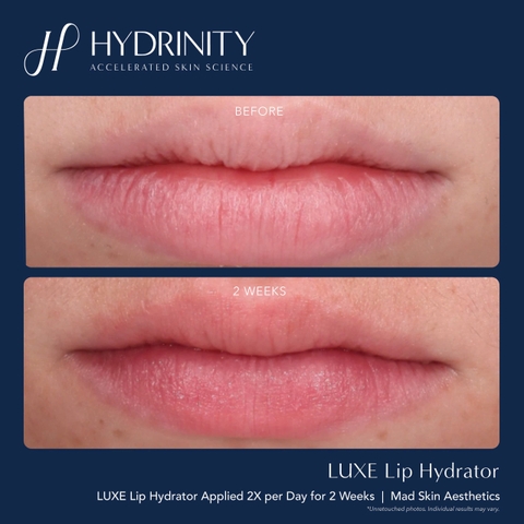 HYDRINITY LUXE LIP HYDRATOR: Khoa Học Gặp Gỡ Sang Trọng - "Filler Không Tiêm" Cho Đôi Môi Căng Mọng