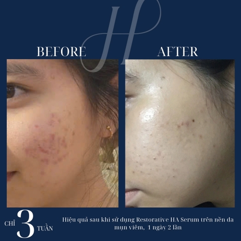 HYDRINITY Restorative HA Serum: Tinh Chất Cấp Ẩm Chuyên Sâu, Phục Hồi Tức Thì Với HA Siêu Nạp